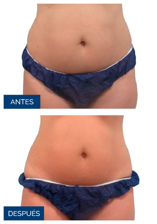 antes-despues