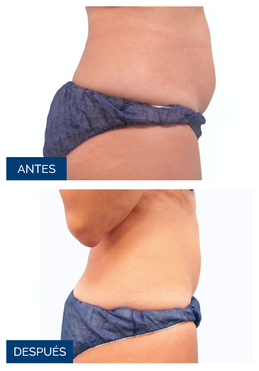 antes-despues