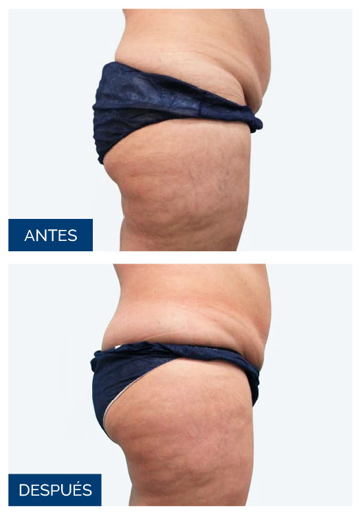 antes-despues